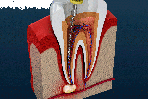 Особенности современного лечения кисты зуба