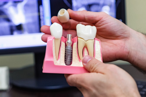 Может ли имплантация зубов проводиться за один день