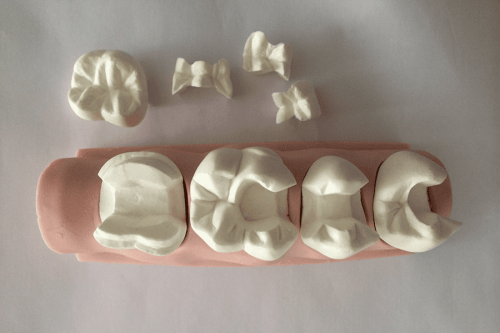 Ортопедическое лечение вкладками разрушенных зубов