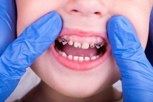 Наиболее распространённые заболевания зубов и ротовой полости у детей