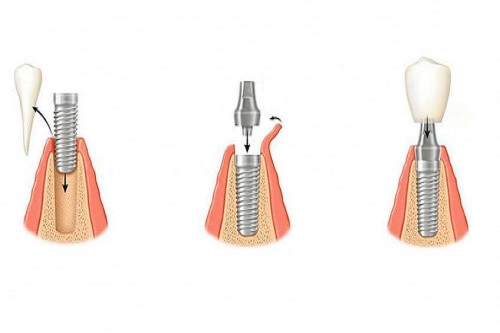 Основные этапы развития зубного протезирования