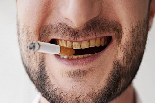 Можно ли курить до и после имплантации зубов?
