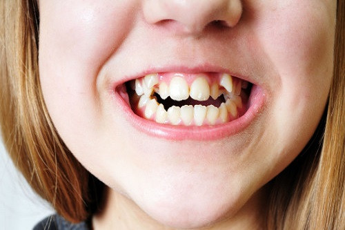 Отчего возникают аномалии зубных рядов и как они проявляются
