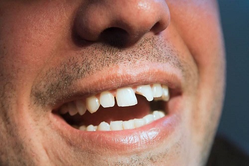 Что делать с выбитым, сломанным или вывихнутым зубом и как его лечить