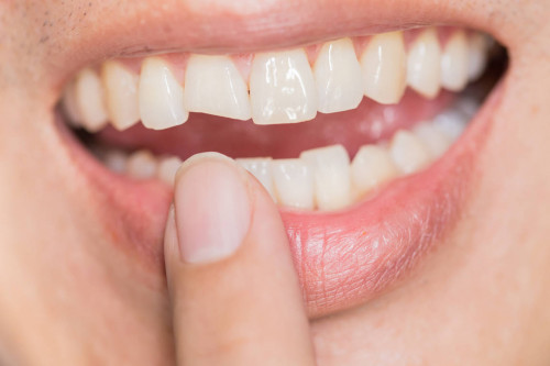 Что делать, если зуб откололся, сломался или на нем появилась трещина