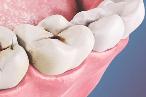 Кариес: особенности стоматологического заболевания