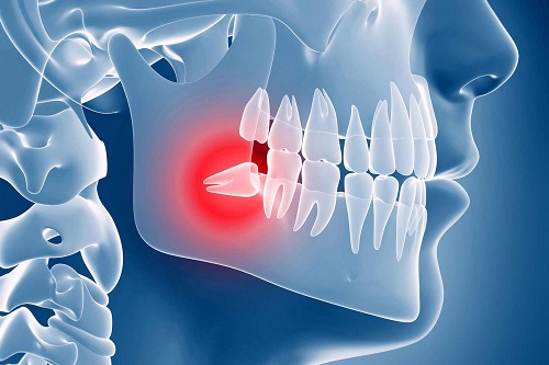 Какие бывают проблемы с зубами мудрости и как их лечить