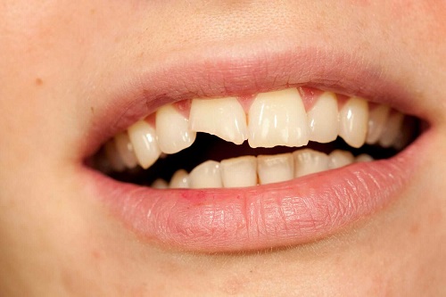 Восстановление зуба после частичного скола