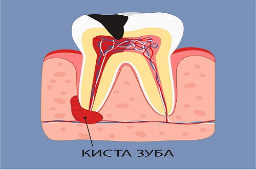 Киста зуба: что это такое, как ее распознать и лечить