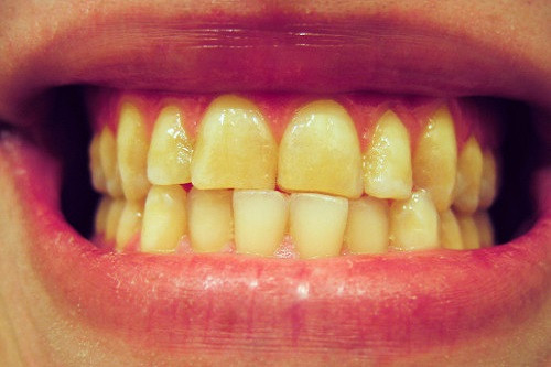 Причины некариозного поражения зубов.Их лечение и профилактика