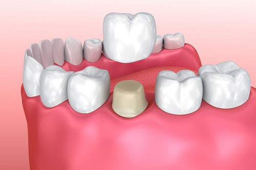 Особенности основных видов зубных коронок
