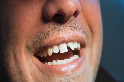 Можно ли удалить поврежденные зубы без боли