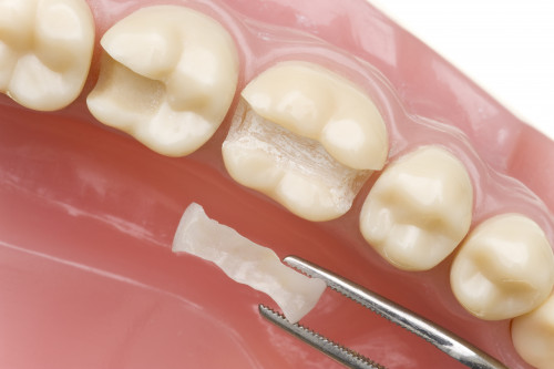 Основные методы микропротезирования зубов