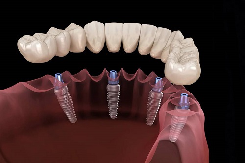 Что такое рациональное протезирование зубов