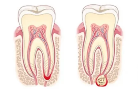 Киста зуба: что это такое, как ее распознать и лечить