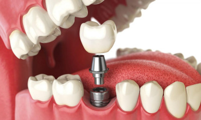 Что собой представляет имплантация зубов?