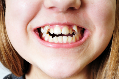 Что делать, если у вашего ребенка кривые зубы