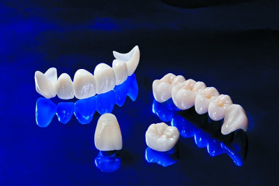 Протезирование зубов с использованием металлокерамики