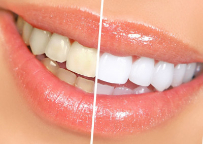 Самые популярные способы отбеливания зубов