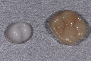 Керамические накладки на зубы