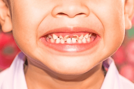 Профилактика стоматологических заболеваний