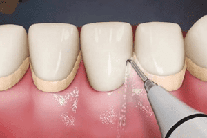 Чистка зубов ультразвуком и 