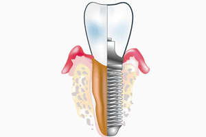 Удаление зубов с одномоментной имплантацией