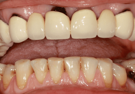 До имплантации зубов в клинике Бест