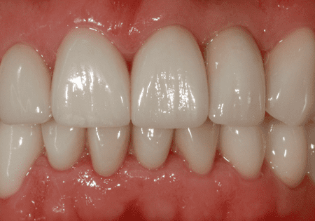 После имплантации зубов в клинике Бест