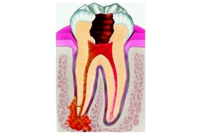 Лечение кисты зуба (периодонтита)