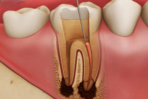 Лечение кисты зуба (периодонтита)