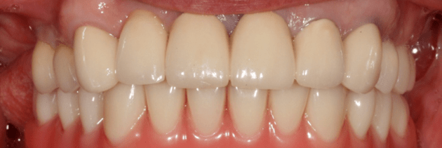 Металлокерамические коронки на зубах верхней челюсти