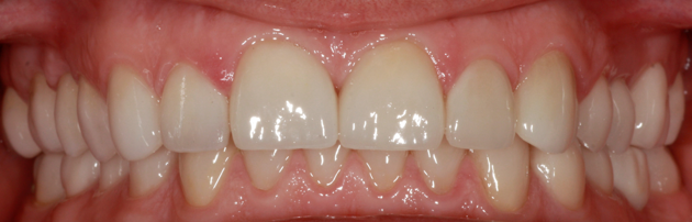 Цельнокерамические виниры на зубах верхней и нижней челюсти