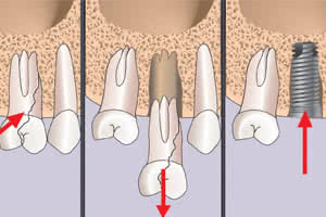 Удаление зубов с одномоментной установкой имплантатов