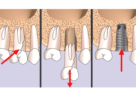 Удаление зубов с имплантацией