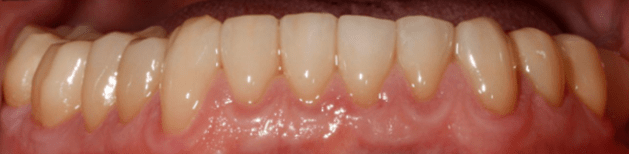 Виниры на зубы нижней челюсти, изготовленные без обтачивания зубов в клинике «Стоматология Бест»