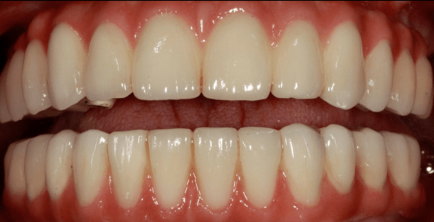 Протезы «Все-на-6» на верхнюю челюсть и «Все-на-4» на нижнюю челюсть в полости рта