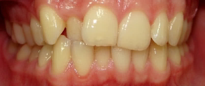 Зубы до процедуры Исправление прикуса