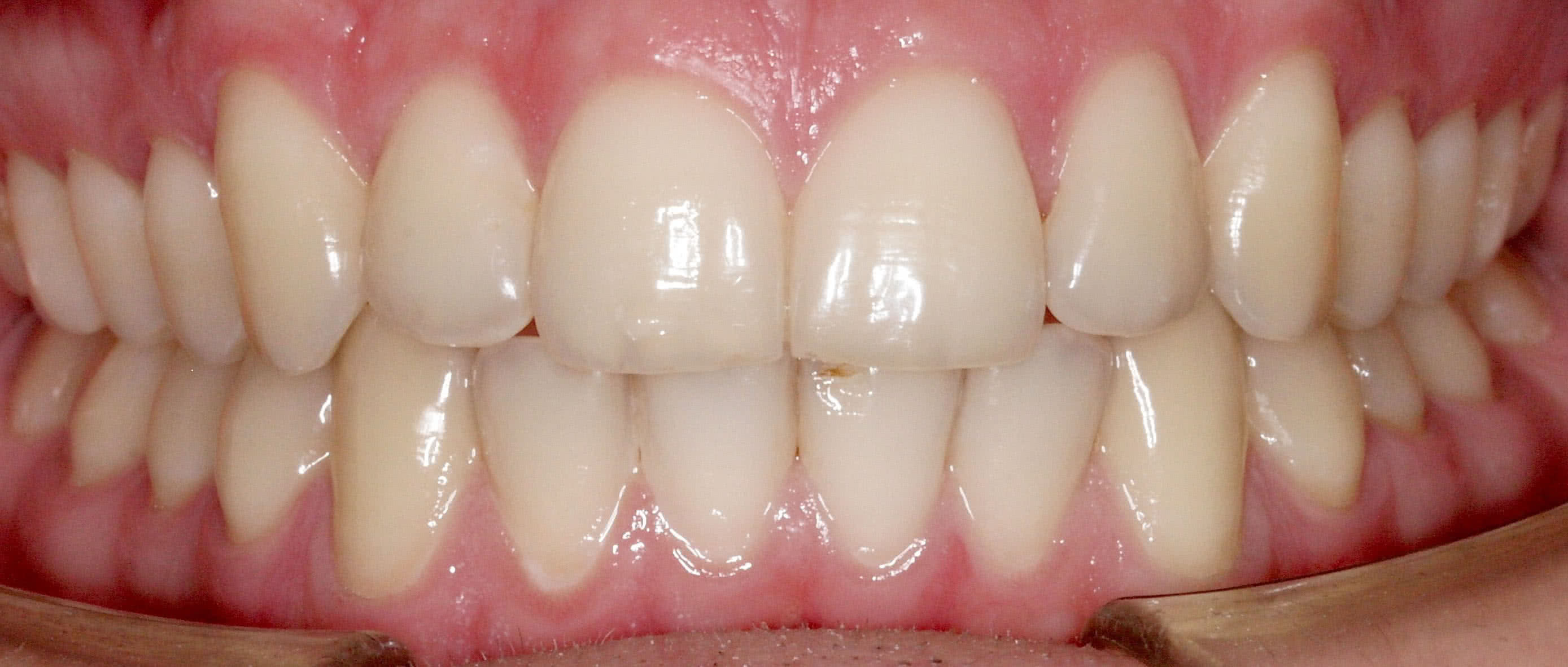 Зубы до процедуры Исправление прикуса