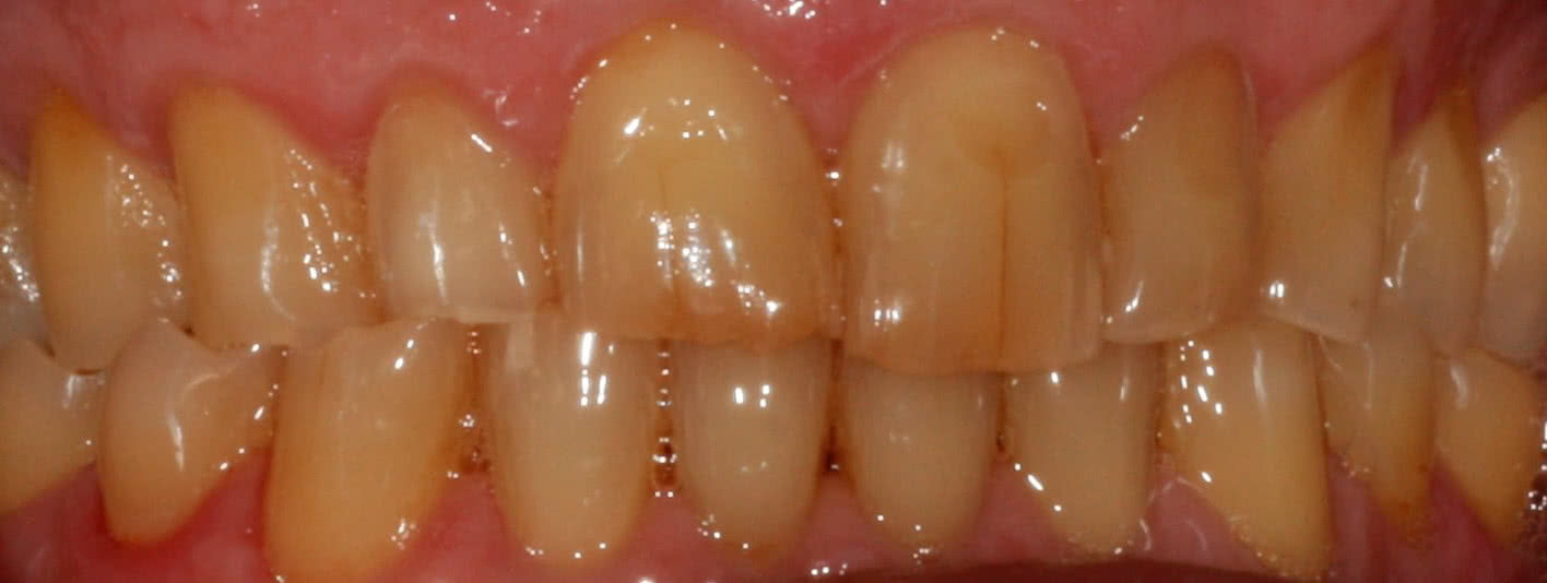 Зубы до процедуры Фотографии отбеливание