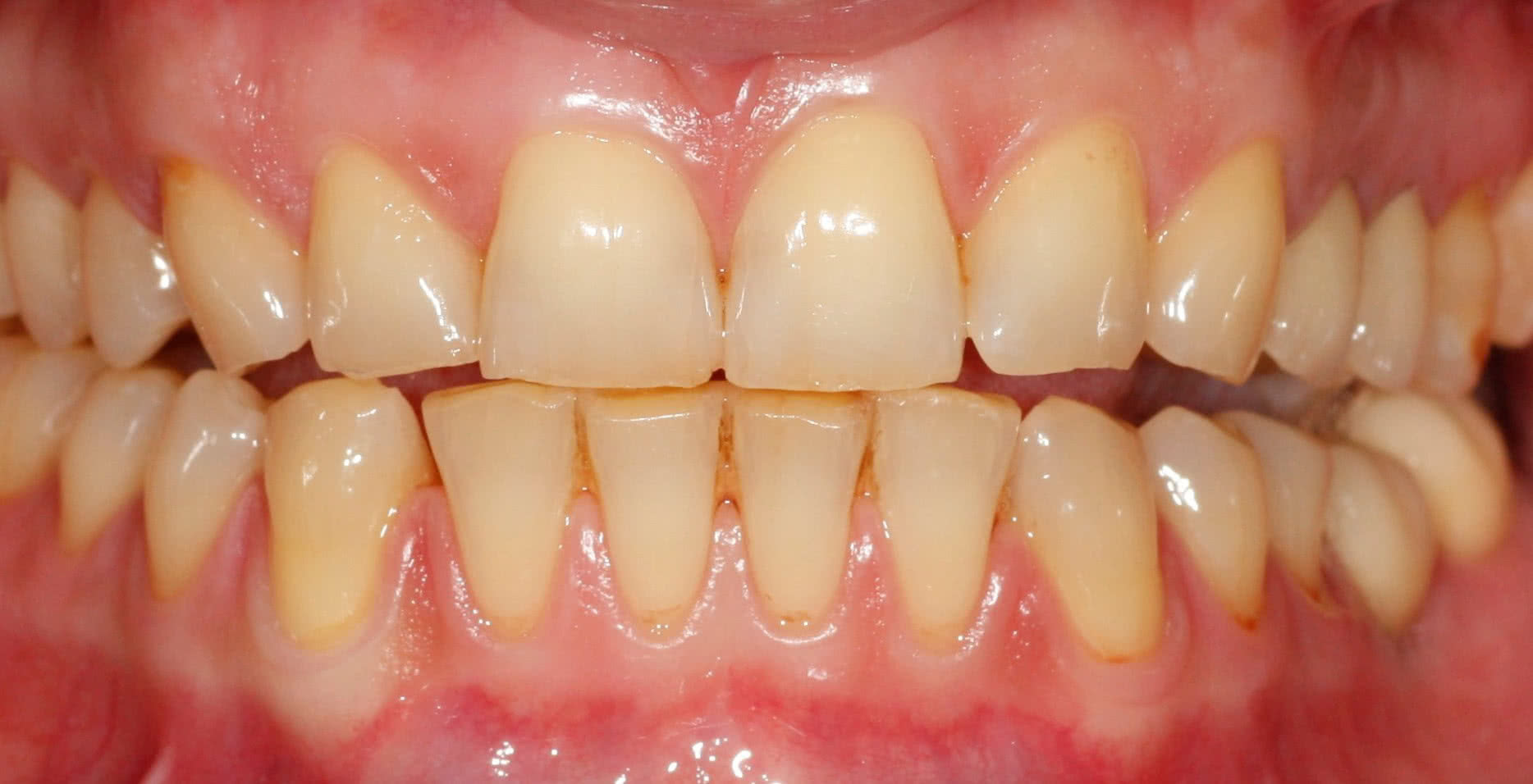 Зубы до процедуры Фотографии отбеливание