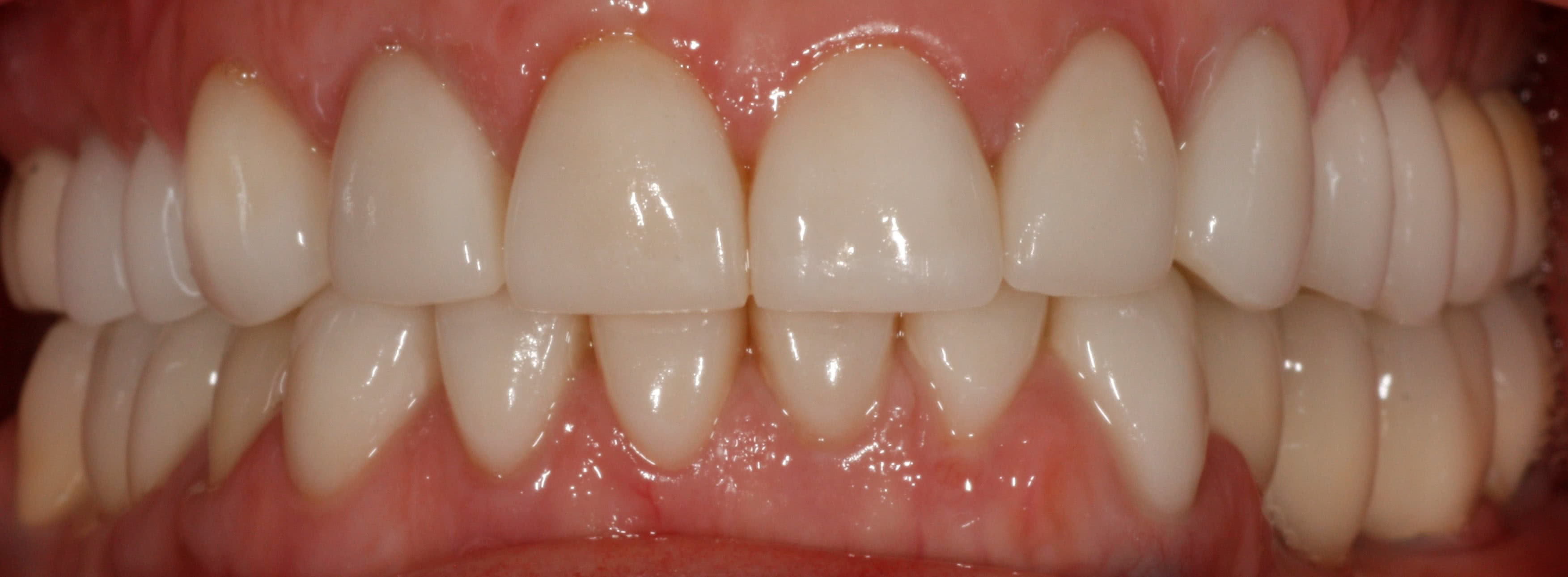 Зубы до процедуры Работы протезирование на имплантатах