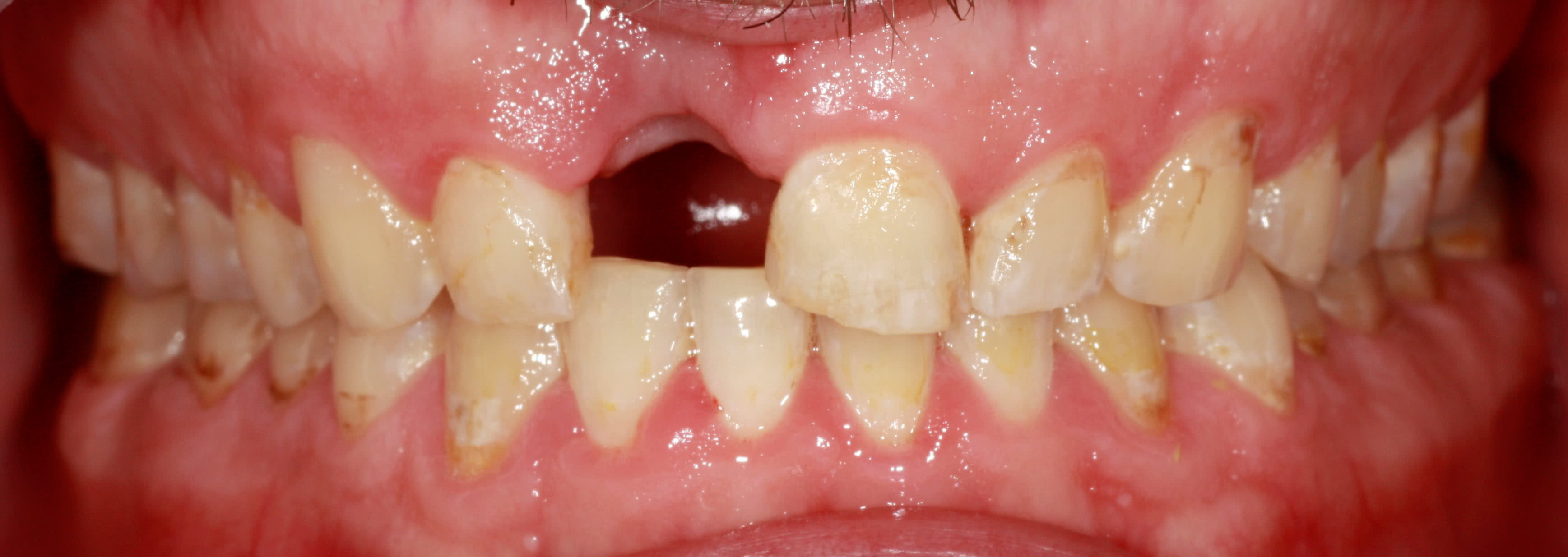 Зубы до процедуры Работы протезирование на имплантатах