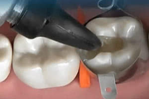 Услуги стоматолога по пломбированию зубов при помощи звука